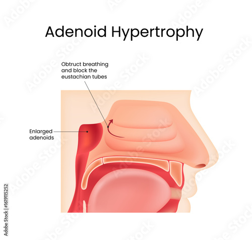 Adenoid Hypertrophy Anatomy and Obstruction