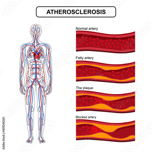 Arteriosclerosis, ischemia, thrombosis. Cholesterol in blood vessels. High LDL and HDL levels. Normal and plaque-clogged arteries. Vector illustration. Design for medical poster, education, clinic.