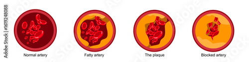Arteriosclerosis, ischemia, thrombosis. Cholesterol in blood vessels. High LDL and HDL levels. Normal and plaque-clogged arteries. Vector illustration. Design for medical poster, education, clinic.