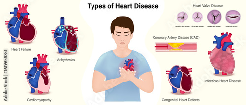 Types of heart disease vector. Heart Failure, Arrhythmias, Cardiomyopathy, Heart Valve disease, Coronary Artery Disease (CAD), Heart Inflammation and Congenital Heart Defect.