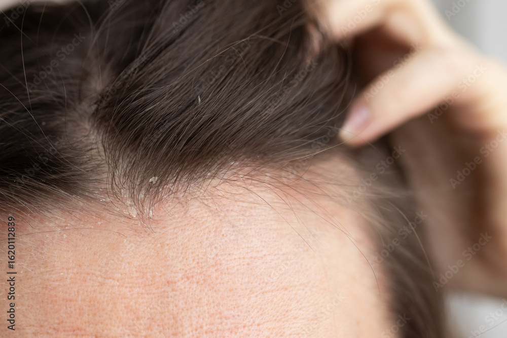 Fototapeta premium Closeup dandruff flakes on the scalp and on the hair.