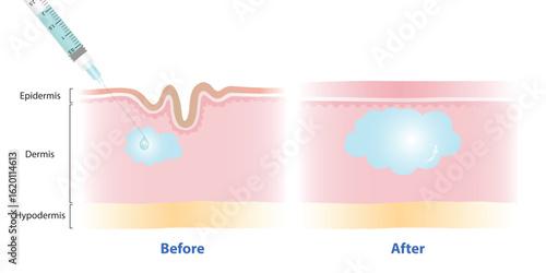 Before and after filler injection under the skin vector illustration on white background. Hyaluronic acid is dermal filler injected to correct the lines and wrinkles. Medical and beauty concept.