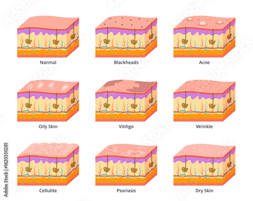 Various skin types scheme. Different skin diseases, layers section, medical infographics, epidermis with problems, blackheads, acne and vitiligo. Wrinkle and psoriasis nowaday vector set