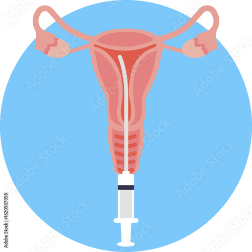 Represents intrauterine insemination (IUI), a fertility treatment to help couples conceive.