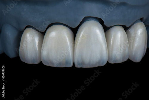 Фотография ceramic emax crowns and veneers bl4 color
