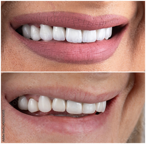 ceramic emax crowns and veneers bl4 color