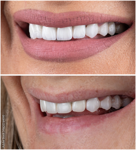 ceramic emax crowns and veneers bl4 color