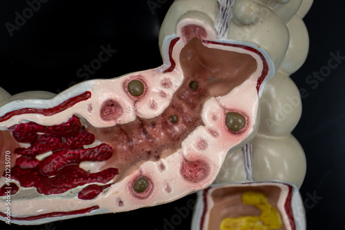 Colon Model Depicting Inflamed Diverticulitis And Mucosal Changes Pathology