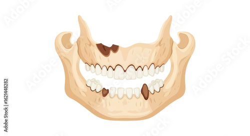 Cartoon Jawbone with Teeth and Cavities Illustration