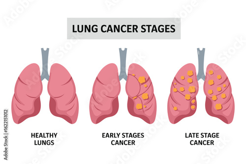 Lung Cancer Staging Diagram Depicting Cancer Spread Across Stages. Useful for Medical Education, Patient Awareness, Oncology Research, and Healthcare Presentation Materials.


