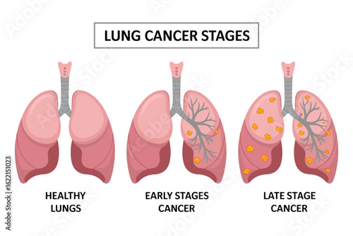 Lung Cancer Staging Diagram Depicting Cancer Spread Across Stages. Useful for Medical Education, Patient Awareness, Oncology Research, and Healthcare Presentation Materials.

