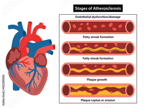 Endothelial Injury as the Trigger Point for Atherosclerosis Development in Blood Vessels Causing Plaque Build-up and Progressive Arterial Narrowing

