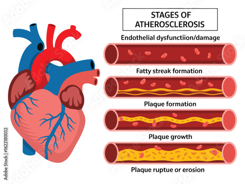 Endothelial Injury as the Trigger Point for Atherosclerosis Development in Blood Vessels Causing Plaque Build-up and Progressive Arterial Narrowing

