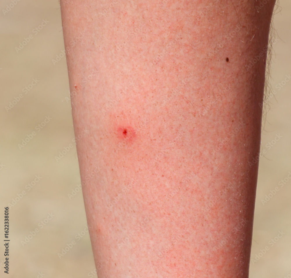 Fototapeta premium A person's leg has a red mark on it