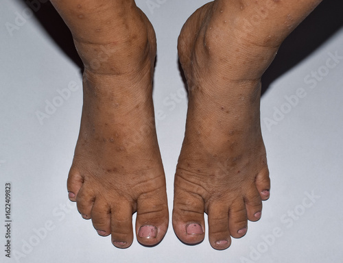 Severe Scabies Infestation on Feet Showing Skin Rash and Lesions