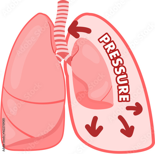 tension Pneumothorax