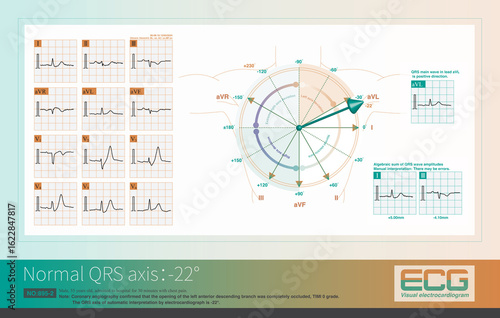 When the QRS axis is at -22°, the main QRS wave is positive in lead aVL and negative in lead aVF, and the average potential is most parallel to the positive side of the aVL axis.
