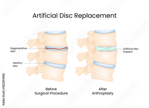 Artificial Disc Replacement Spinal Arthoplasty Illustration