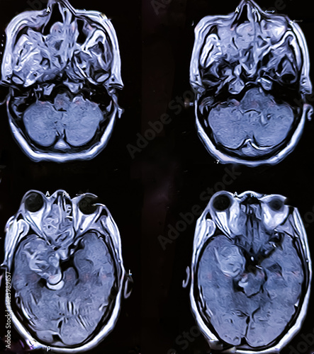 Magnetic resonance imaging (MRI) or CT scan of the brain, sinusitis, sinonasal mass, brain tumours. Metastasis.