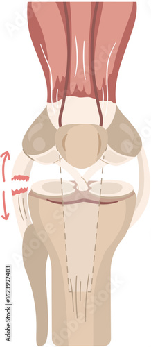 lateral collaterall ligament injury