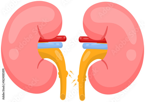 urolithiasis