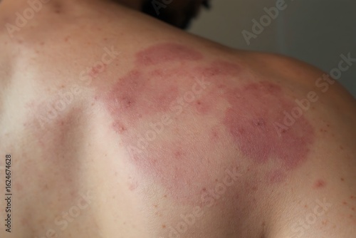 Inflamed Red Patches of Tinea Versicolor on the Shoulder and Back
