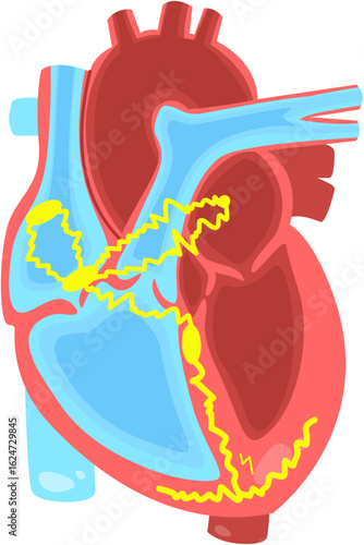 Atrial fibrillation 