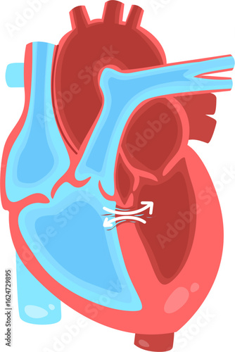 tertralogy of fallot
