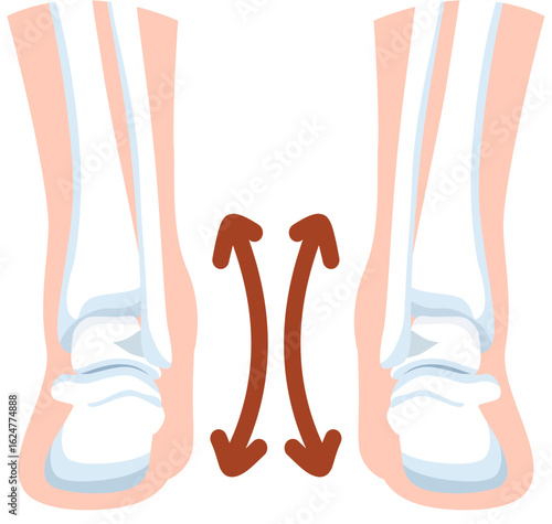 Knock knees