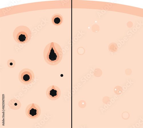 Comparison of skin with and without acne lesions, highlighting the difference in skin texture.