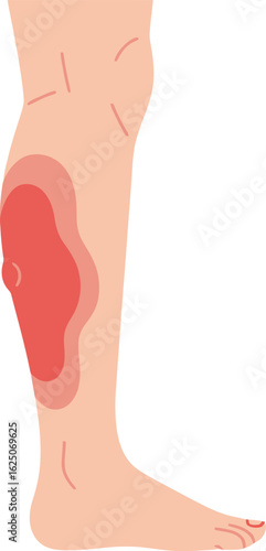 Illustration of a leg with a red, inflamed area on the lower calf, indicating a possible injury or medical condition.
