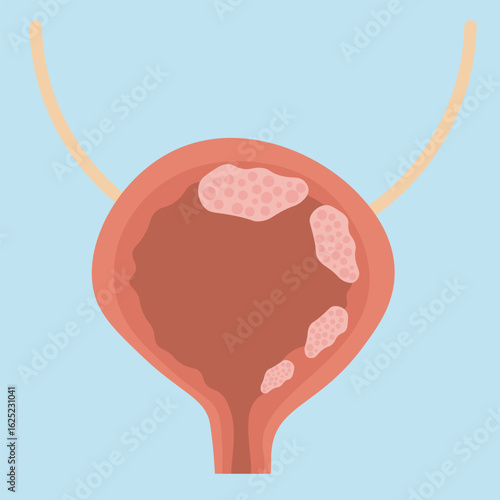 Minimalist bladder cancer vector illustration showing symptoms like blood in urine, pain, frequent urination, and similar diseases such as UTI, kidney stones, and bladder infection. Icon