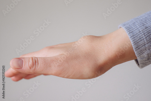 Female right back hand with ganglion cyst on the dorsum,  fluid-filled bump associated with a joint or tendon sheath, close-up view, selected focus.
