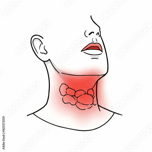 Illustration of inflamed throat with highlighted red areas  