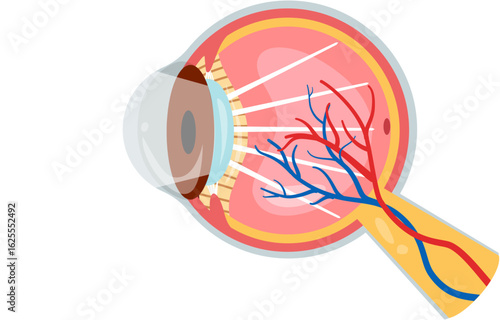 Cataract 