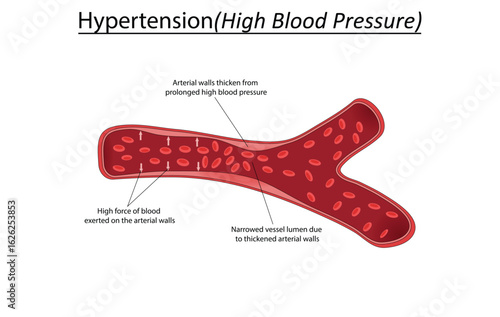 Hypertension (High blood pressure) vector illustration