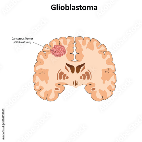Glioblastoma vector illustration