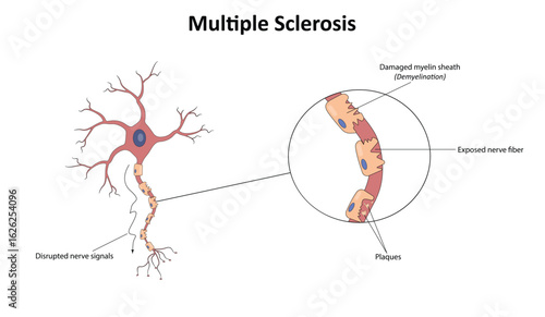 Multiple sclerosis vector illustration