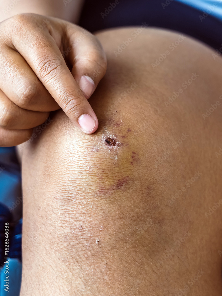 Fototapeta premium Young woman has bruises and scabs on knees from a fall. The injuries are healing, with scabs beginning to form over wounds. Wound scab injury on leg skin. Knee injury. Abrasion, contusion, scratch.