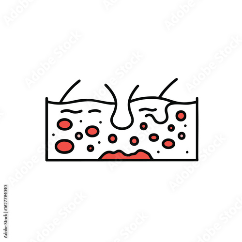 Detailed illustration depicting a cross-section of human skin with inflamed pores and red blemishes, symbolizing common dermatological issues like acne or infection.