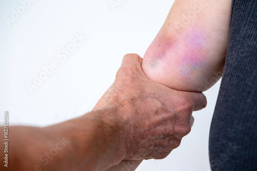Female hand with big bruise, tightly grabbed by male hand, victim aggression, aggression, abuse concept, domestic physical violence, injured woman, fear expression