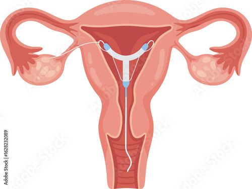 Anatomical illustration of the female reproductive system with an intrauterine device IUD inserted for contraception.