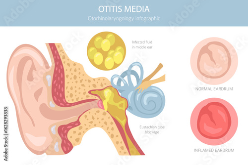 Otitis media. Infection in the middle ear. Otological disorders infographic. Vector illustration