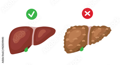 Healthy liver and liver cirrhosis. Vector illustration isolated on white background.