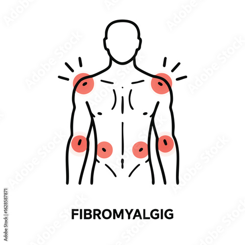 An illustrative outline of a human torso highlighting common pain points associated with fibromyalgia, depicting chronic widespread musculoskeletal discomfort.
