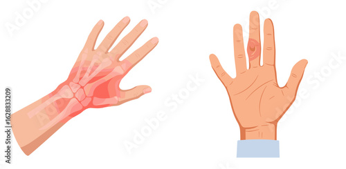 Hand showing arthritis symptoms with swelling and detail illustration, transparent background, isolated, vector, set  