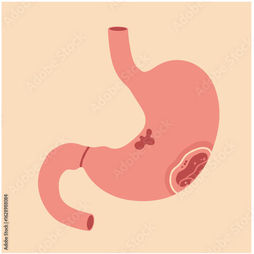 Stomach anatomy diagram showing ulcer formation on surface  