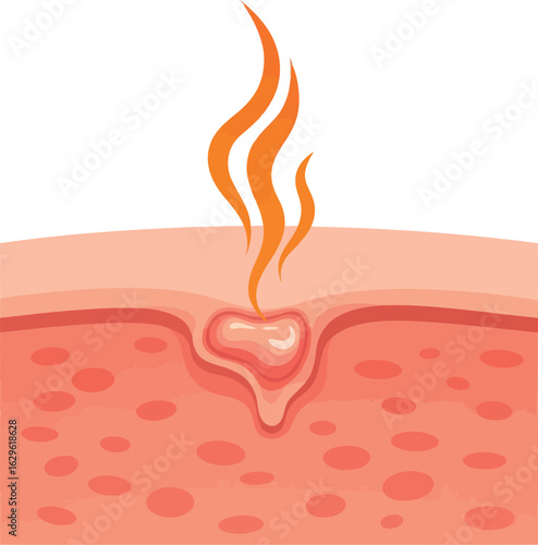 Vector illustration of an inflamed skin lesion showing a red swollen pustule with heat radiating from the pore.