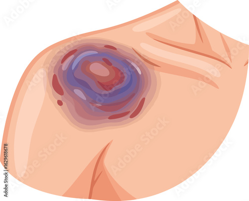 A detailed vector illustration of a large severe bruise on a human shoulder showing purple blue and red discoloration from a contusion.