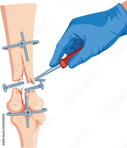 Gloved surgeons hand performing orthopedic surgery fixing a fractured bone with a screwdriver and metal screws.